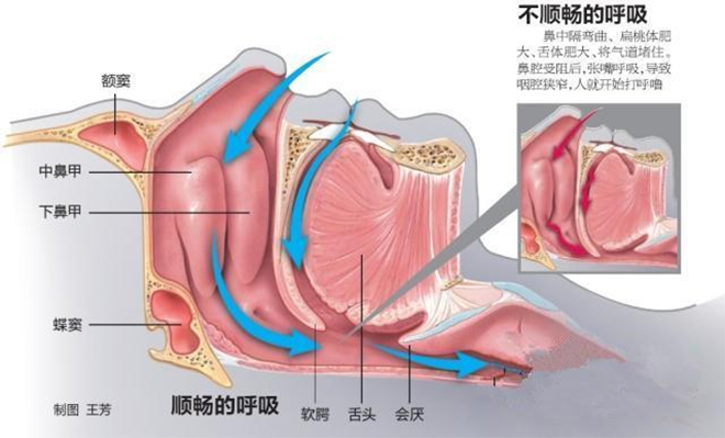 家用呼吸機(jī)是如何治療打鼾