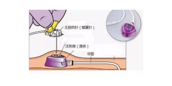 什么是植入式靜脈輸液港