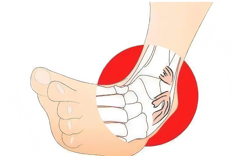 踝關節扭傷