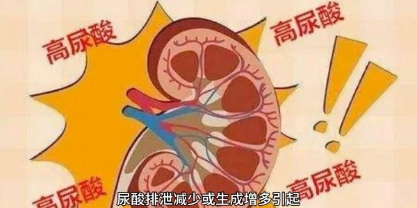 突然痛風(fēng)？別再只怪啤酒和燒烤！真正的“尿酸元兇”遠(yuǎn)比你想的多！
